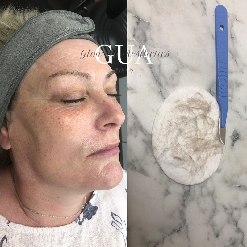 Dermaplane facial