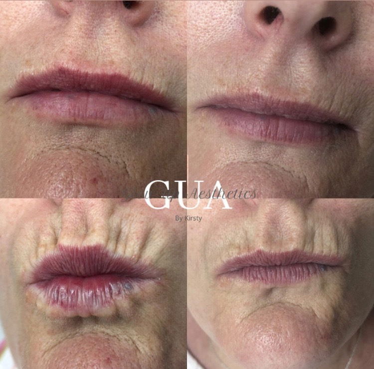 Advanced Botulinum toxin