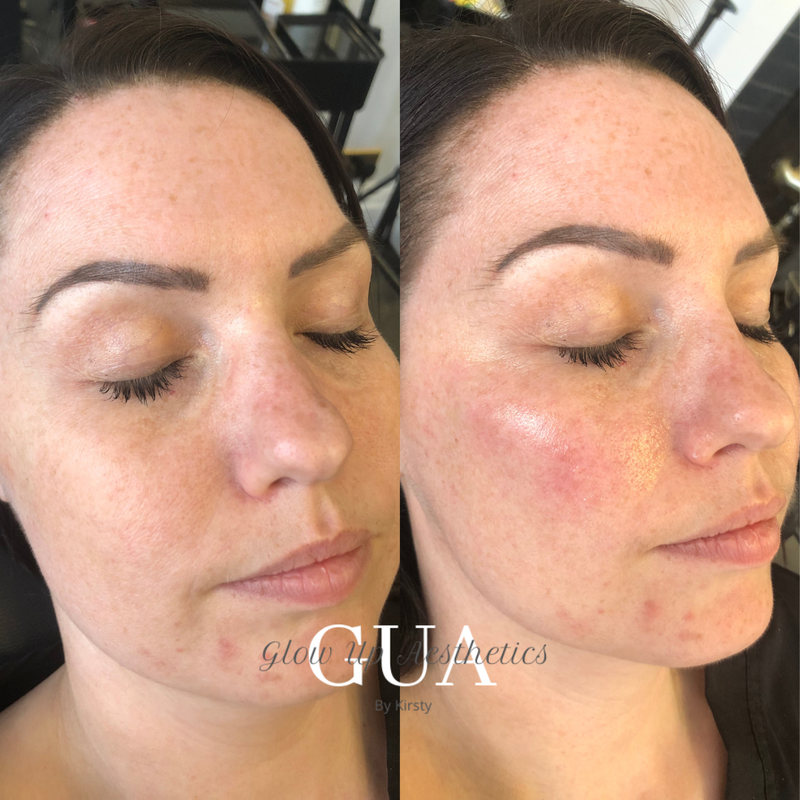 Cheek Augmentation