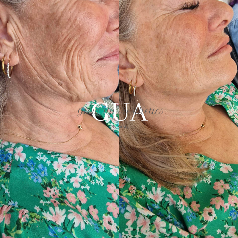Jaw / Jowl Augmentation