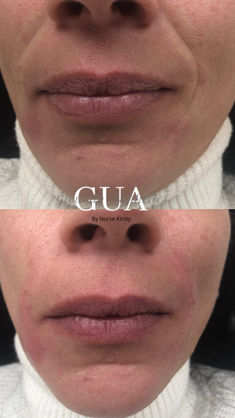 Marionette line Augmentation