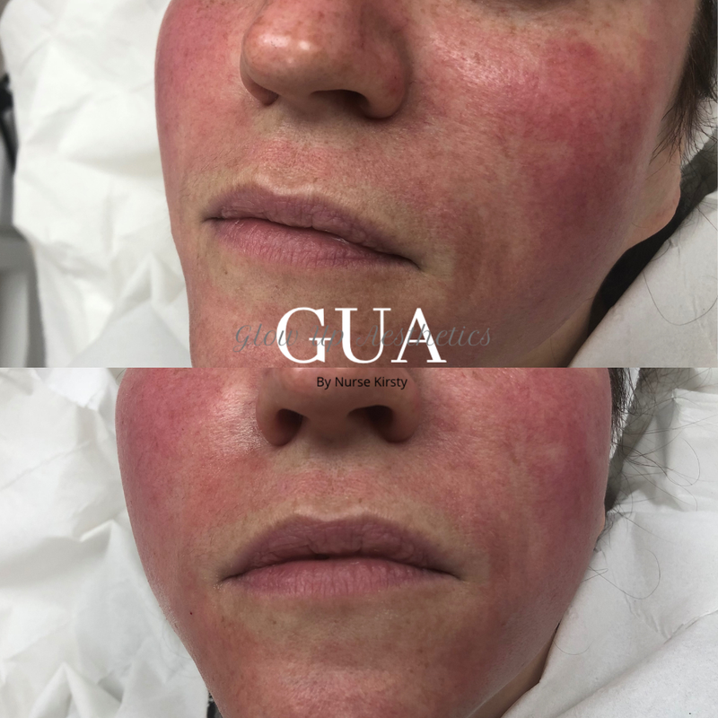 Nasolabial augmentation