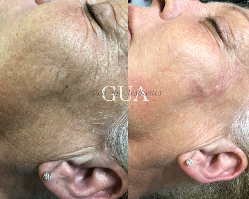 PRP Injections (Natural skin booster)