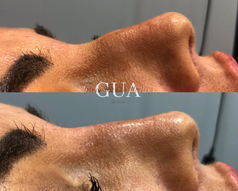 Rhinoplasty (Non surgical)