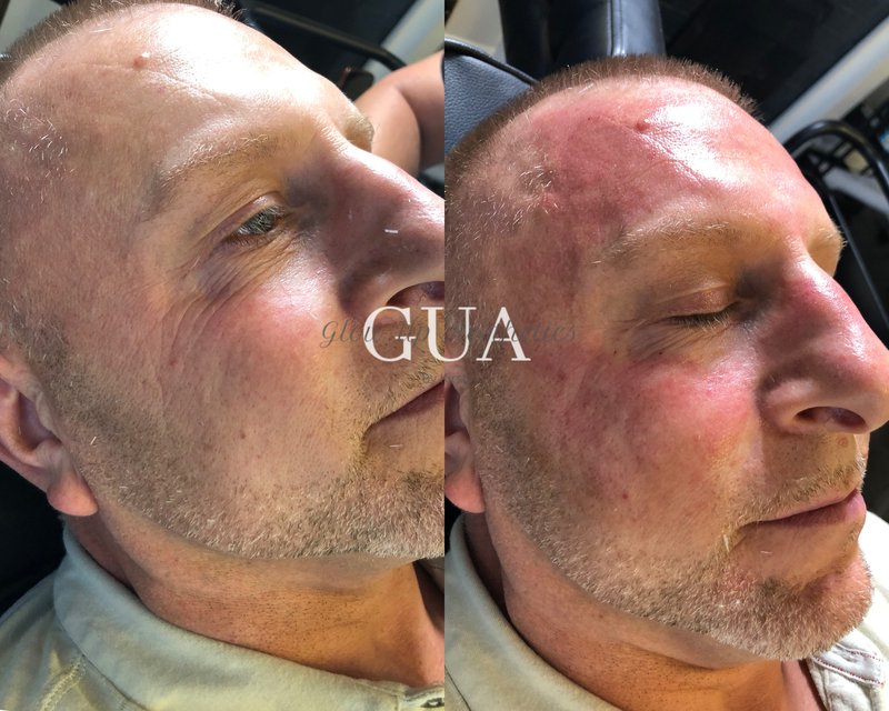 Micro-needling facial