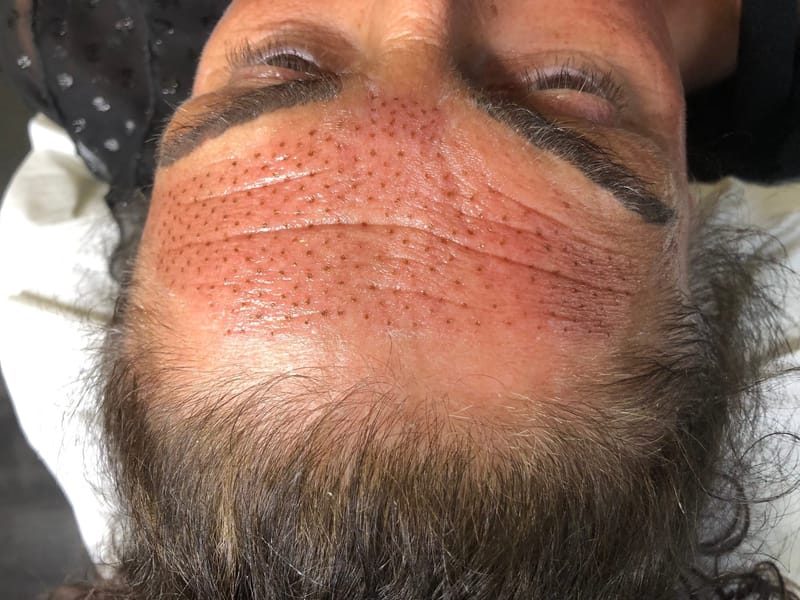 Plasma pen skin tightening