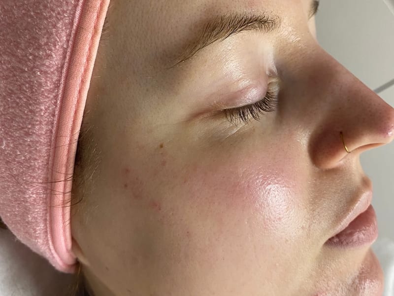 Microdermabrasion facial