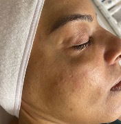Carboxy therapy facial