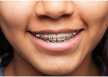 The Benefits of Choosing the Right Orthodontist in Miami: Why It Matters