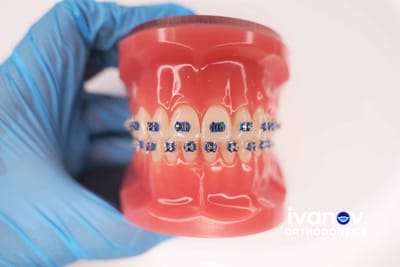 Things You Should Know Before Getting Braces Miami