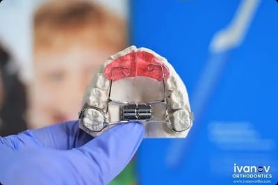 How a Palate Expander Works and When Kids Need It