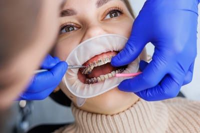 Why an Orthodontist Miramar Provides Better Results Than Mail-Order Aligners