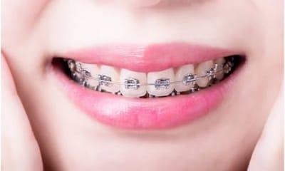 6 Tips for Adjusting to Life After Getting Braces Near Me