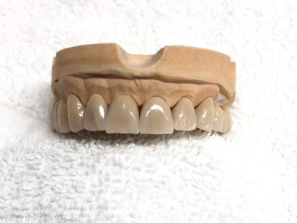 Inlays, Kronen, Brücken