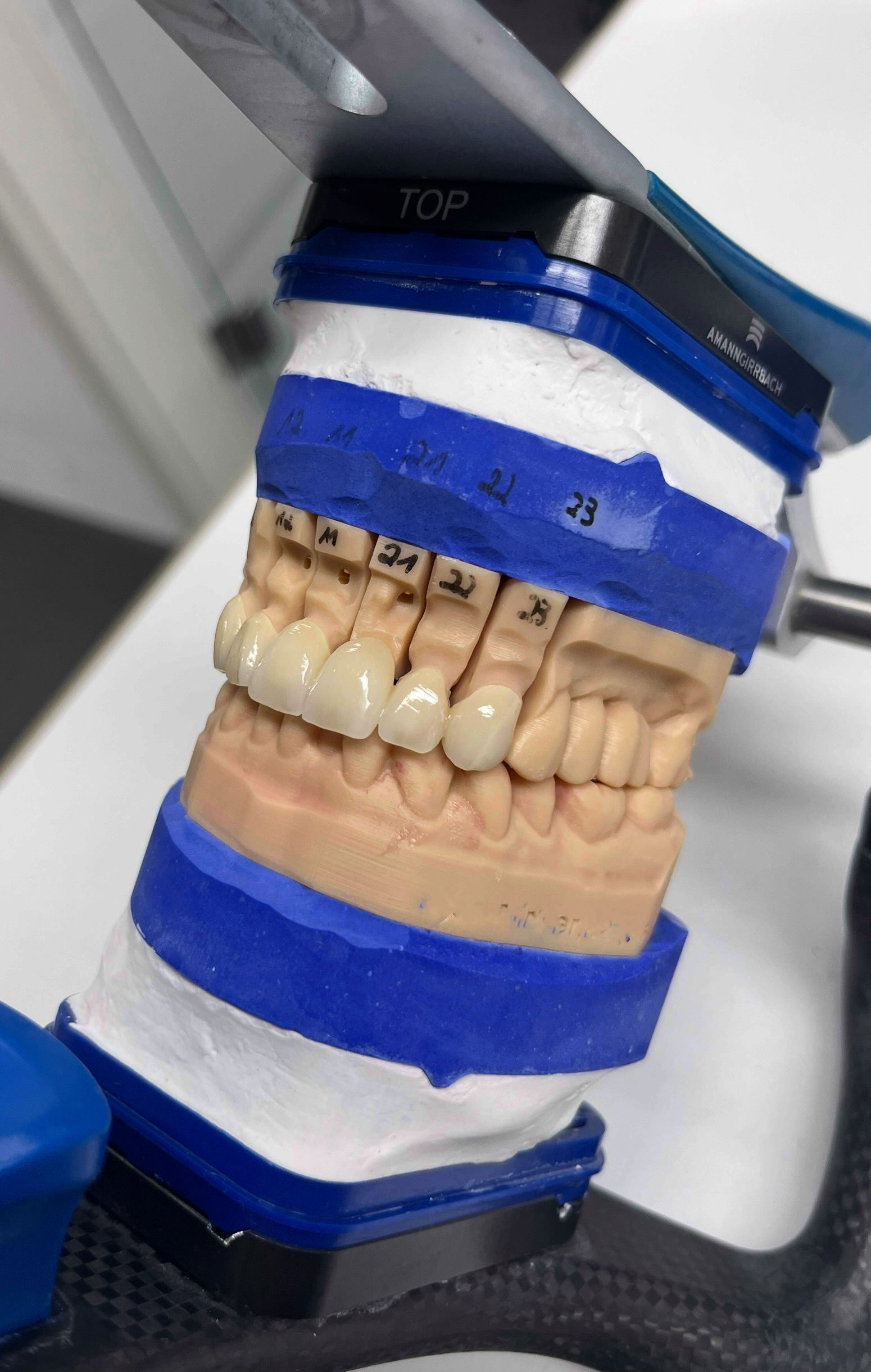 Inlays, Kronen, Brücken