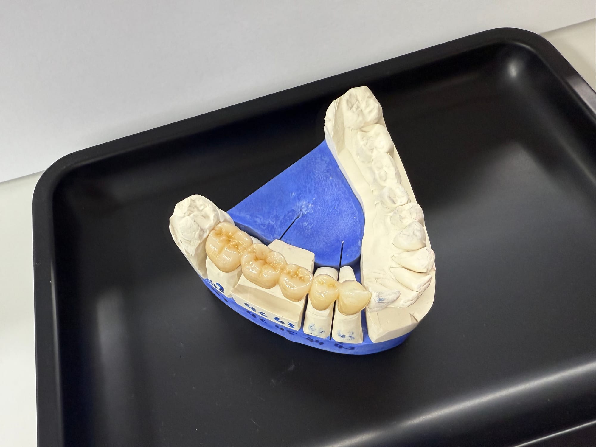 Inlays, Kronen, Brücken