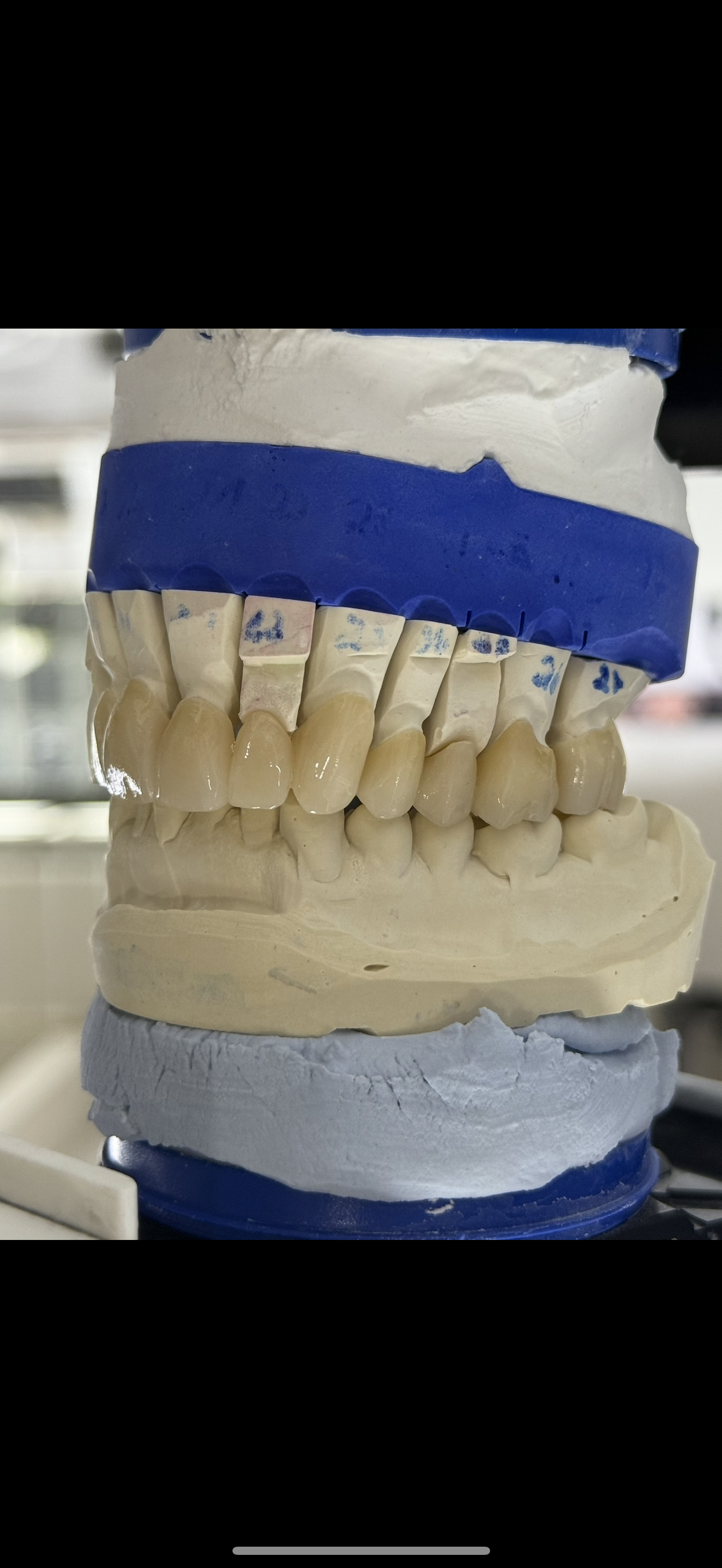 Inlays, Kronen, Brücken