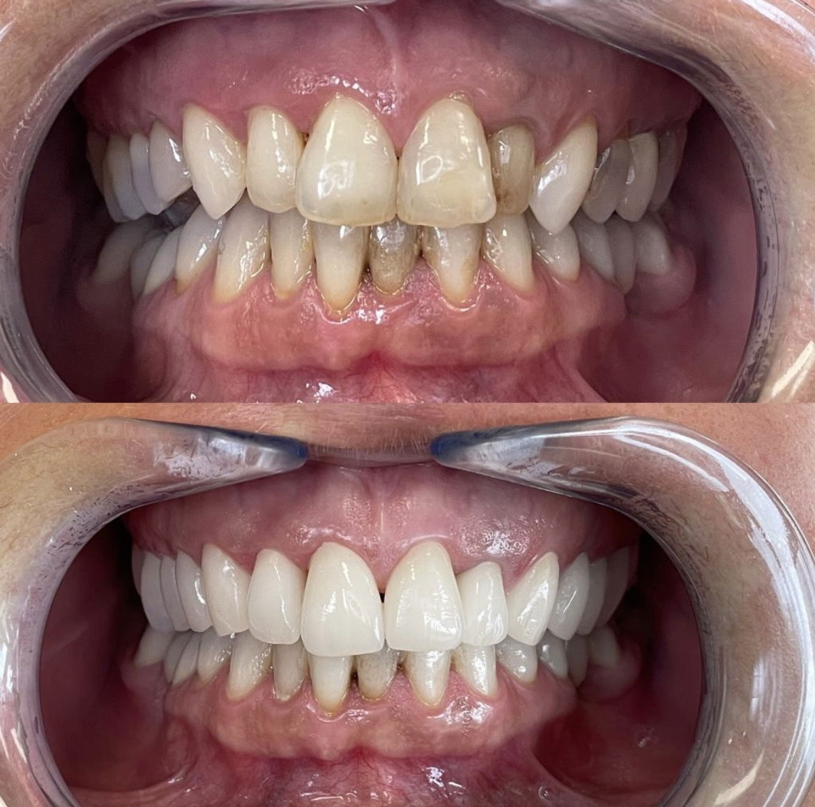 Inlays, Kronen, Brücken