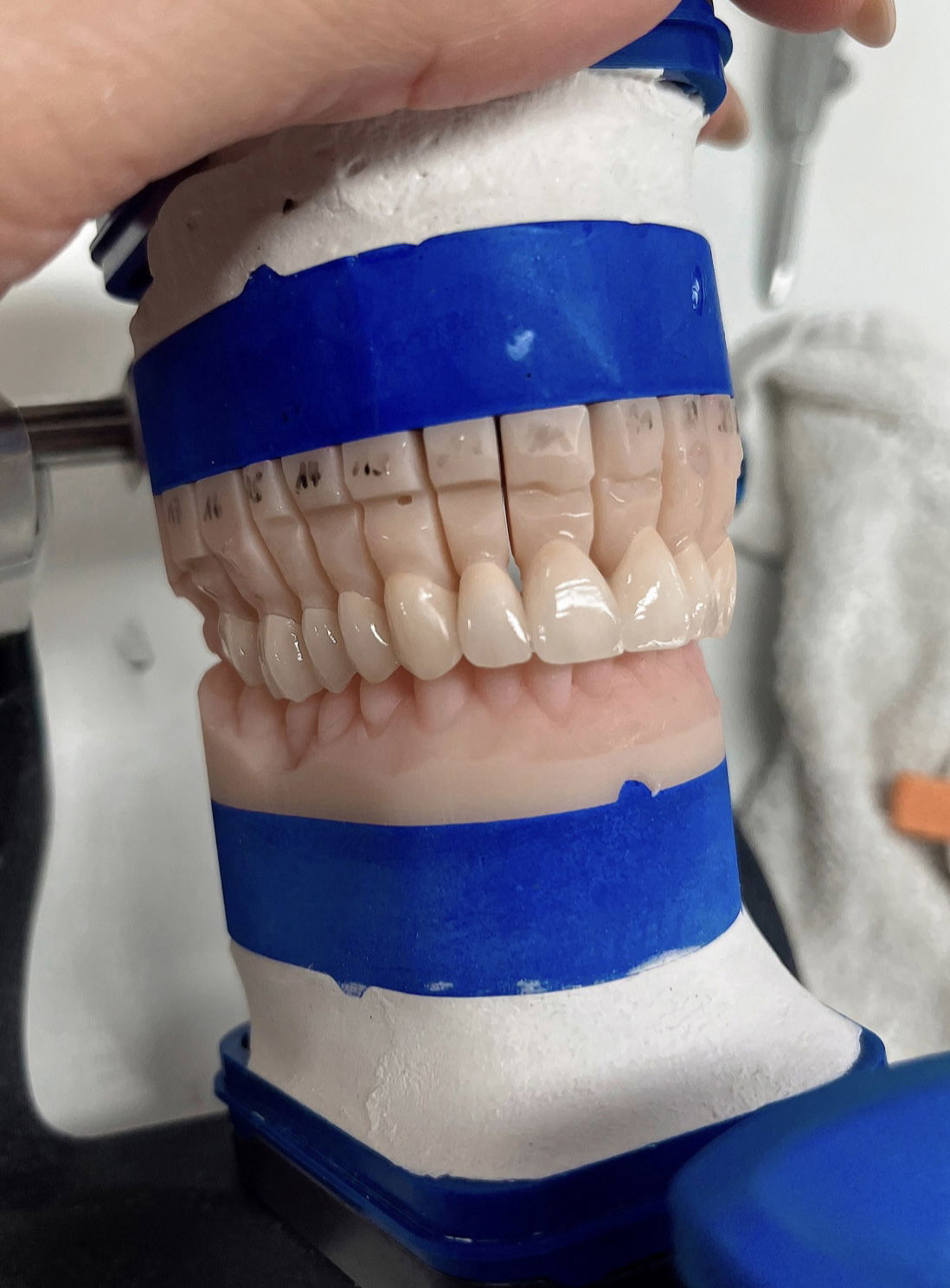 Inlays, Kronen, Brücken