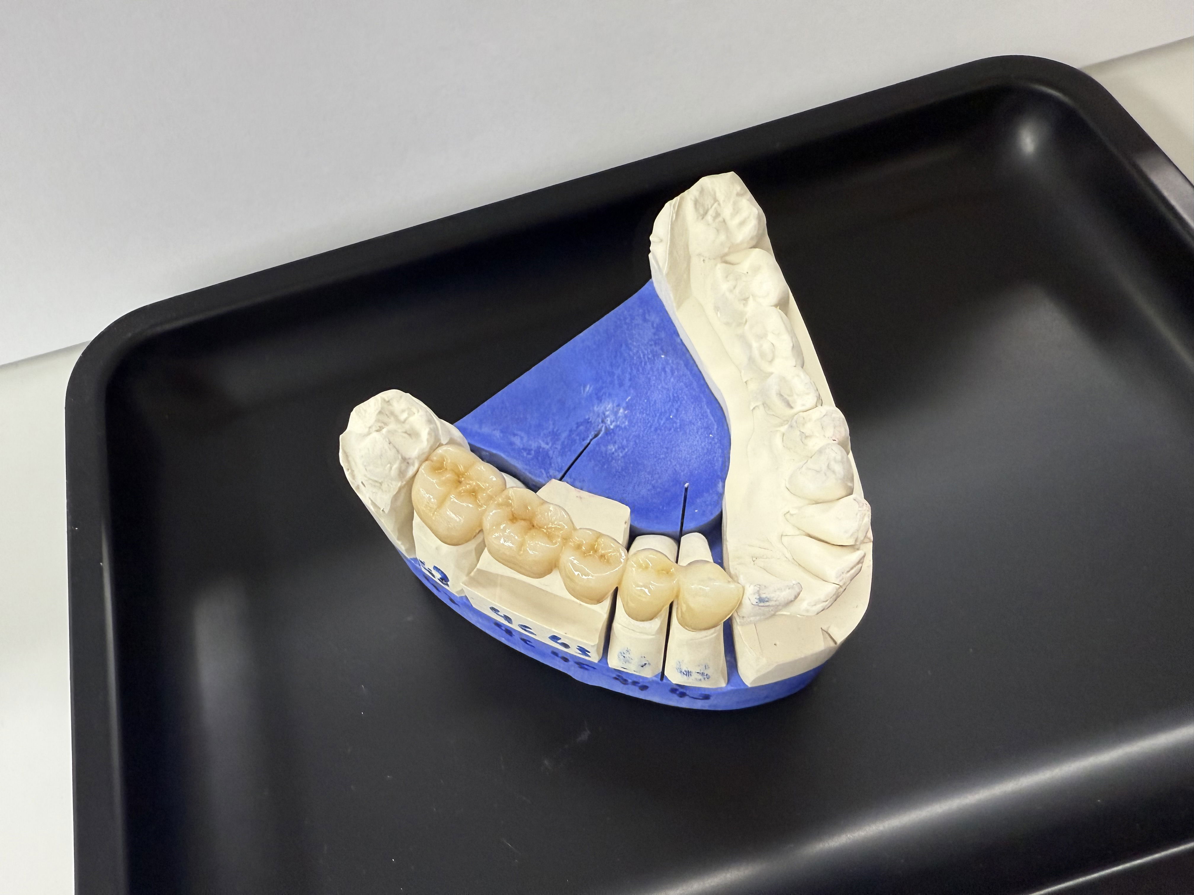 Inlays, Kronen, Brücken