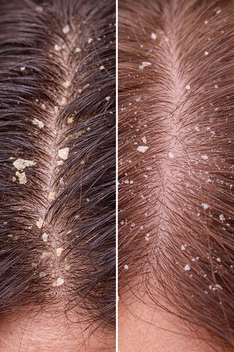 قشرة أم جفاف فروة الرأس؟ كيف تفرق بينهم + أفضل روتين لكل حالة