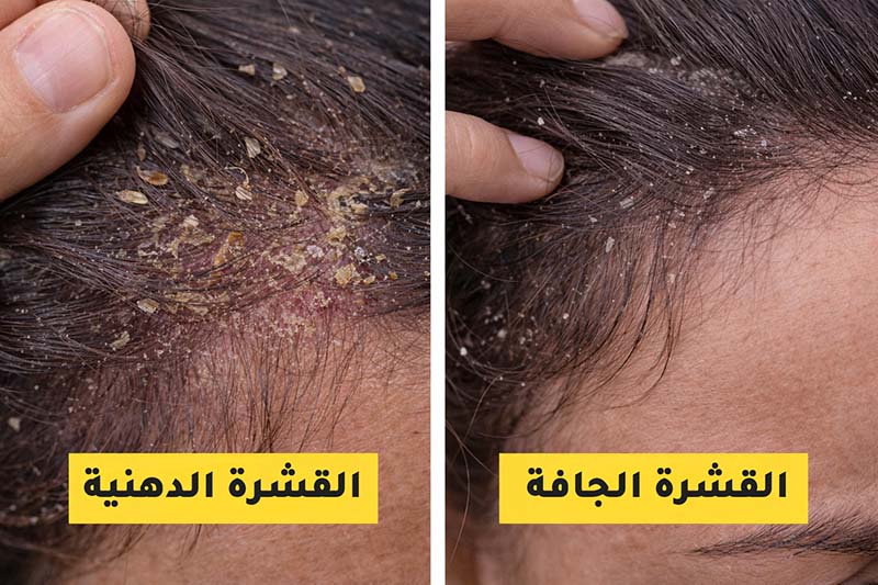 القشرة الدهنية vs القشرة الجافة: كيف تفرق بينها؟ وأفضل علاج لكل نوع