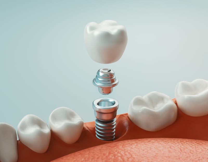 IMPLANTES DENTALES