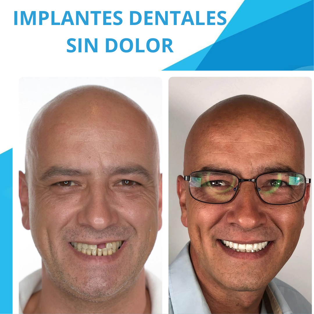 Implantes Dentales: Precios y Costos Descubre la excelencia en implantes dentales en nuestro centro. Nuestro equipo de expertos ofrece atención personalizada con tecnología avanzada para resultados duraderos. Recupera tu sonrisa y confianza hoy. ¡Consulta ya para una experiencia cómoda y transformadora!