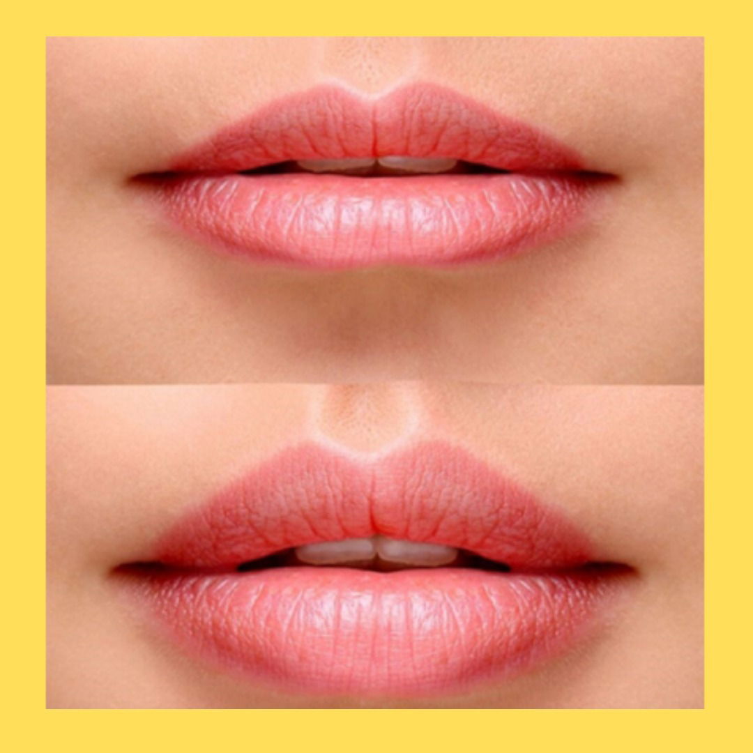 Descubre la perfección en cada sonrisa con nuestros tratamientos de ácido hialurónico para labios. En nuestro centro, fusionamos la ciencia avanzada con la expertise estética para brindarte resultados excepcionales. Transforma tus labios en una expresión sublime de belleza natural, realzando su forma y volumen de manera armoniosa. Nuestros profesionales altamente calificados garantizan una aplicación precisa y cómoda, logrando una apariencia natural y equilibrada. Sumérgete en el lujo de la belleza labial y descubre una versión más radiante de ti misma. Agenda tu consulta hoy y da vida a la sonrisa perfecta que siempre has deseado