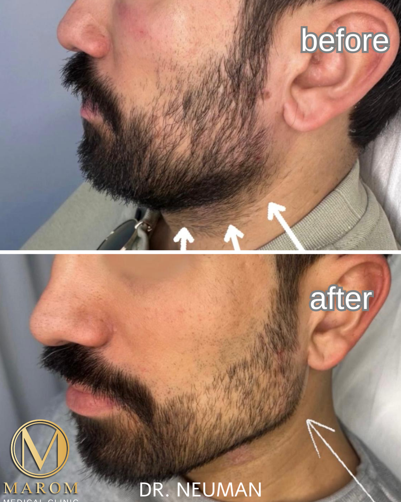 פיסול פנים מלא קו לסת \ פיסול אף \ נזולביאל \ עצמות לחיים...