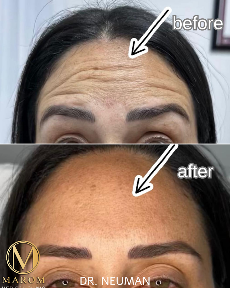 מתיחה וזוהר בזכות בוטוקס