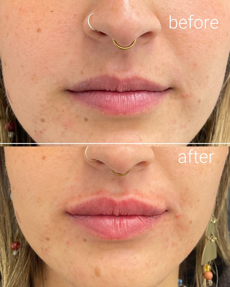 מילוי שפתיים 