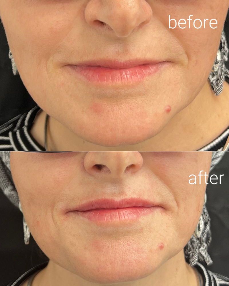 מילוי שפתיים 