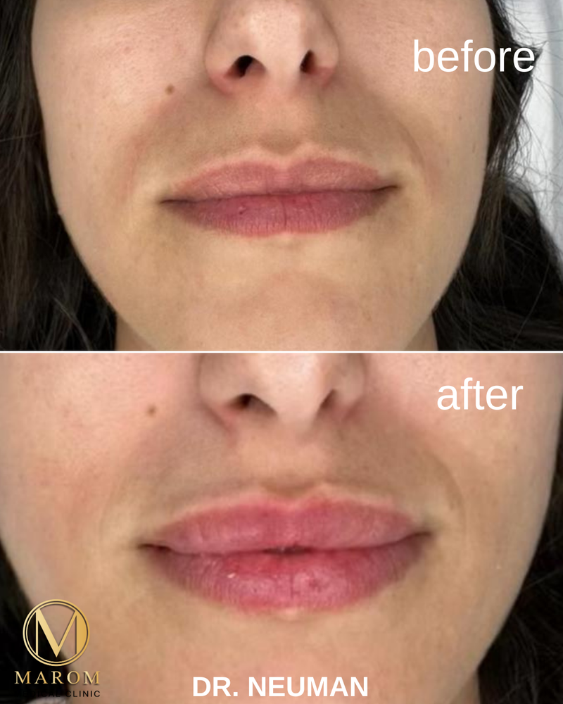 מילוי שפתיים 