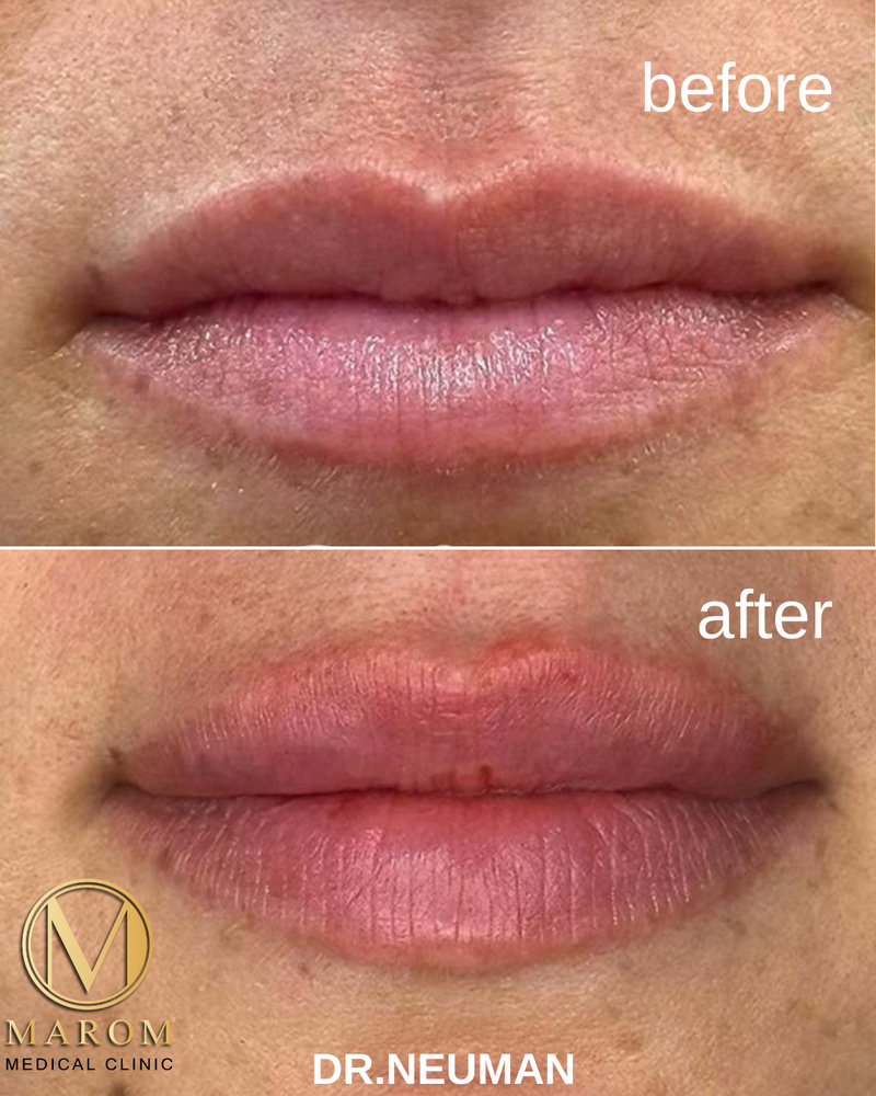 מילוי שפתיים 