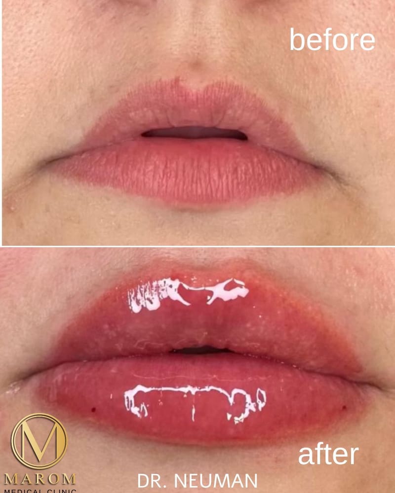 מילוי שפתיים 