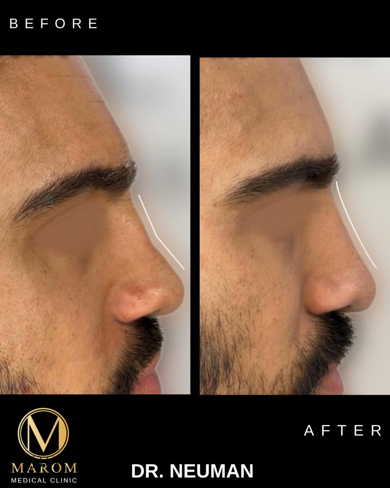 פיסול פנים מלא קו לסת \ פיסול אף \ נזולביאל \ עצמות לחיים...