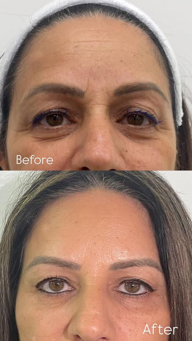 מתיחה וזוהר בזכות בוטוקס