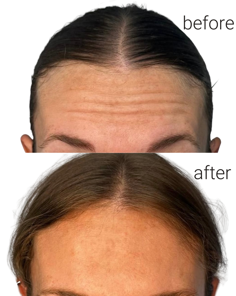 מתיחה וזוהר בזכות בוטוקס