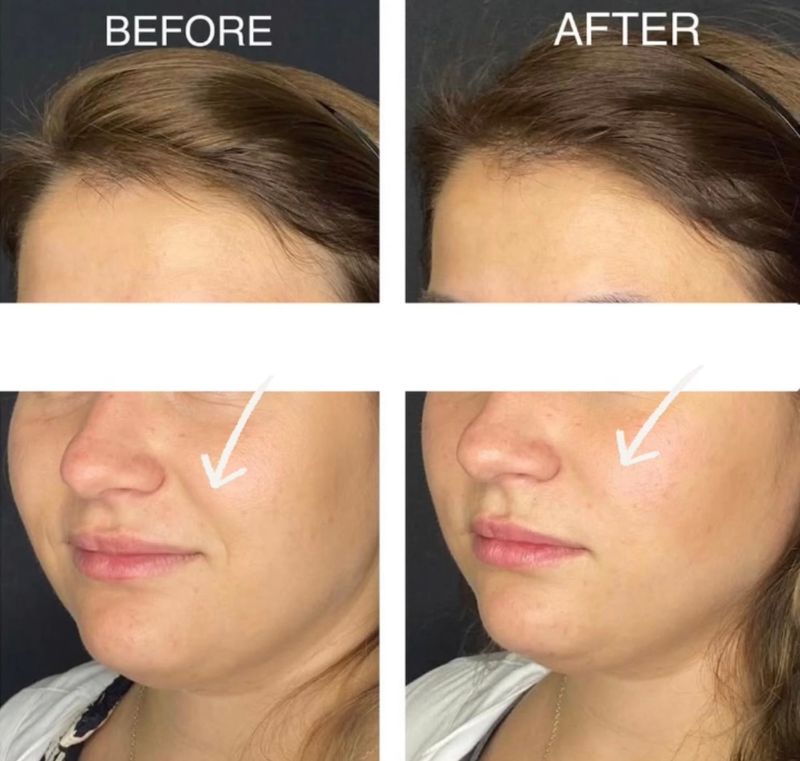 פיסול פנים מלא קו לסת \ פיסול אף \ נזולביאל \ עצמות לחיים...