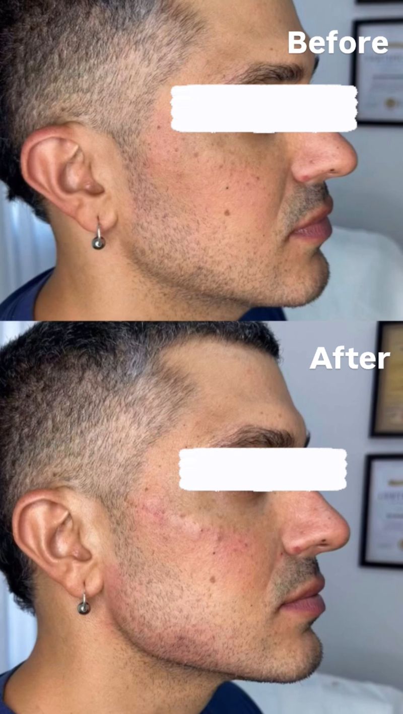 פיסול פנים מלא קו לסת \ פיסול אף \ נזולביאל \ עצמות לחיים...