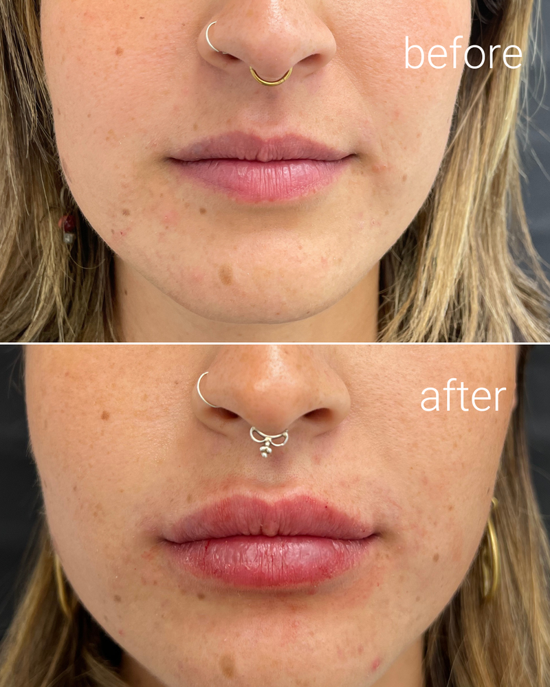 מילוי שפתיים 