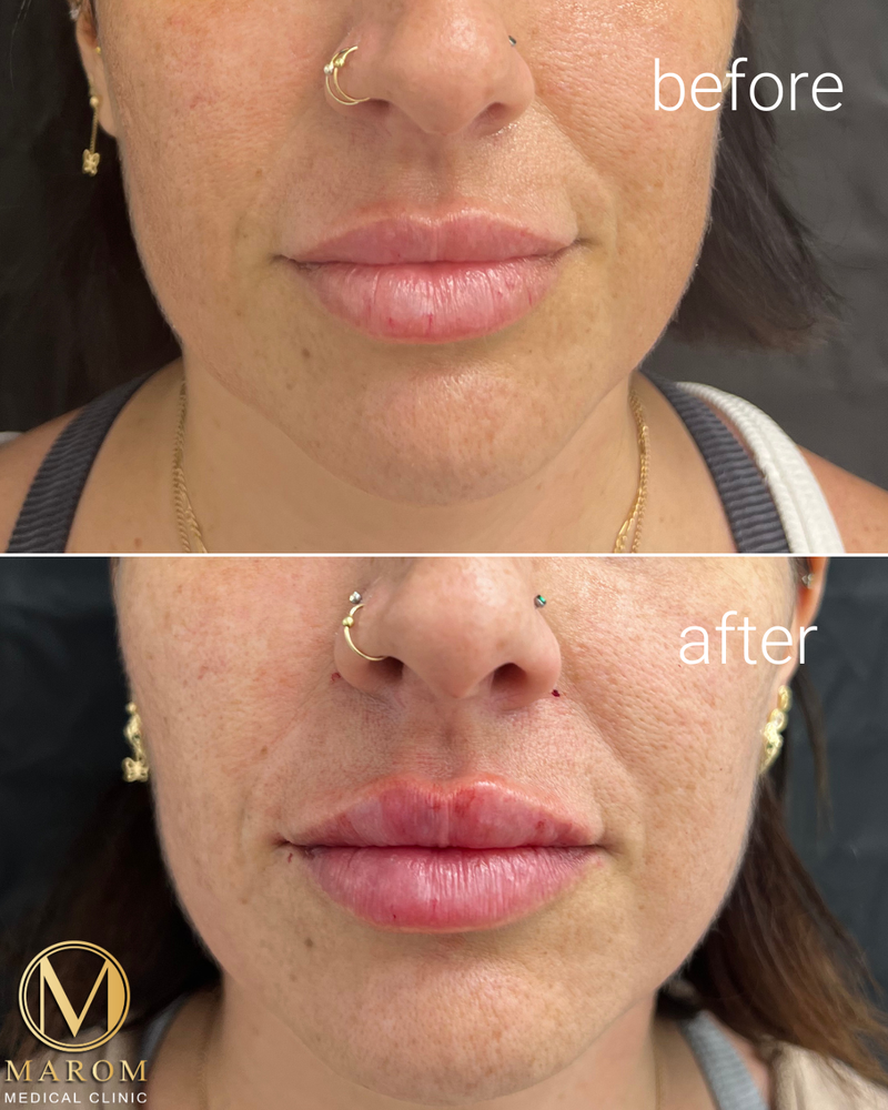 מילוי שפתיים 