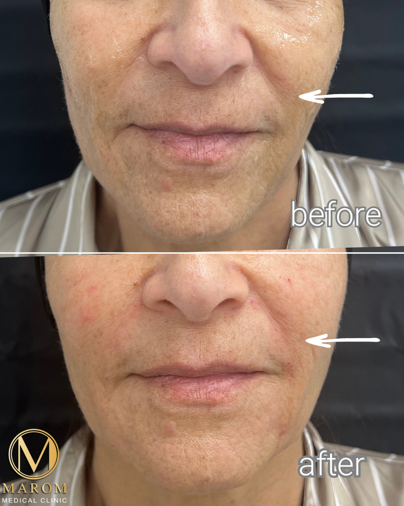 פיסול פנים מלא קו לסת \ פיסול אף \ נזולביאל \ עצמות לחיים...