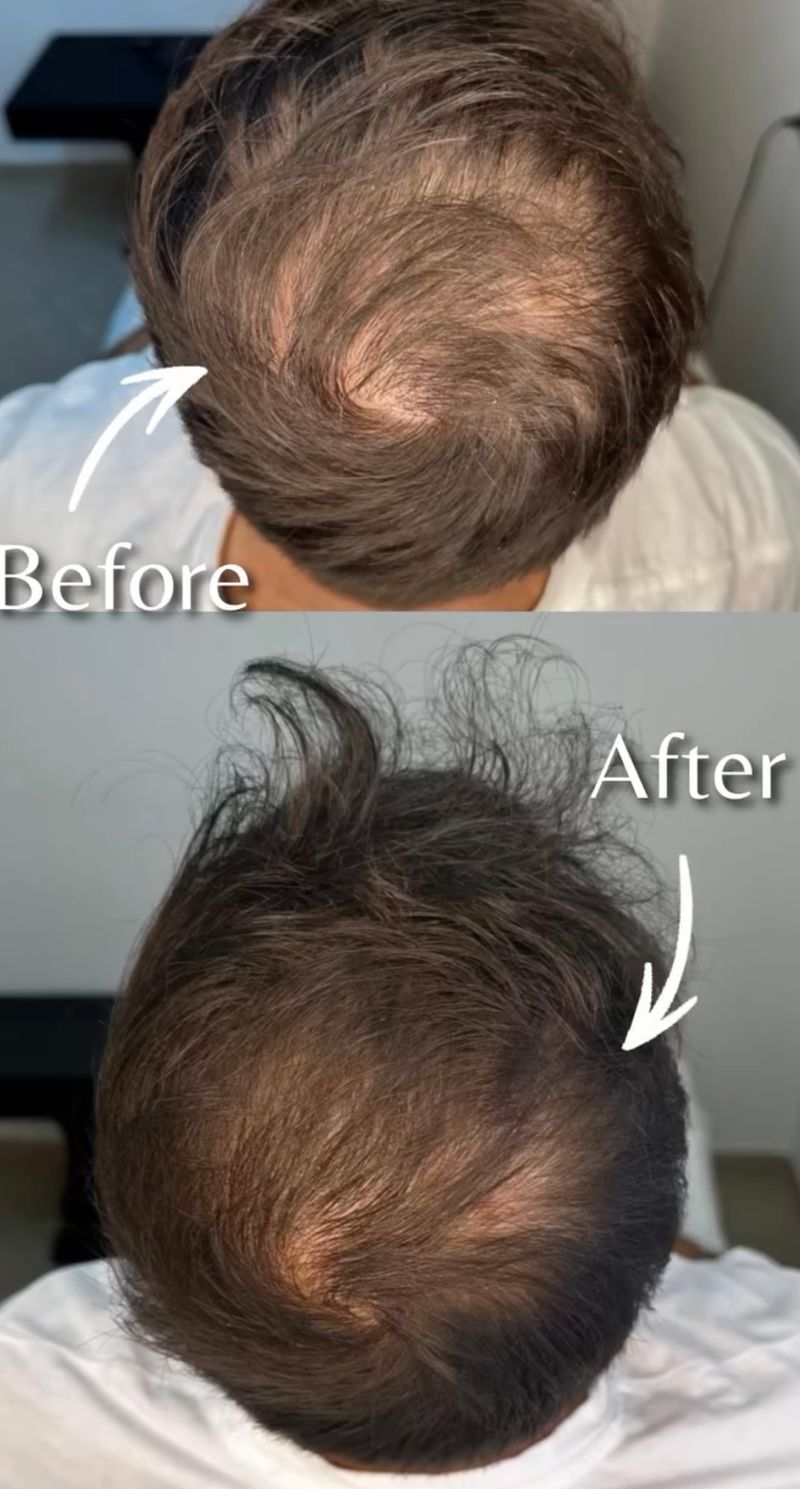 טיפול PRP לעצירת נשירת השיער ועיבוי השערה 