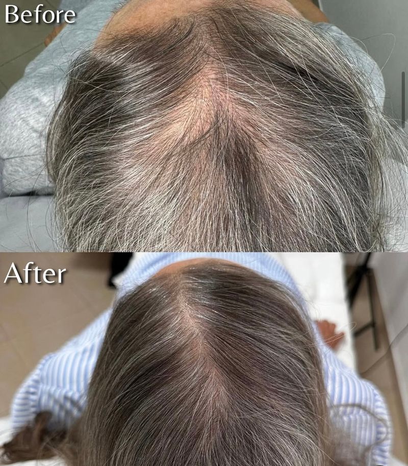 טיפול PRP לעצירת נשירת השיער ועיבוי השערה 