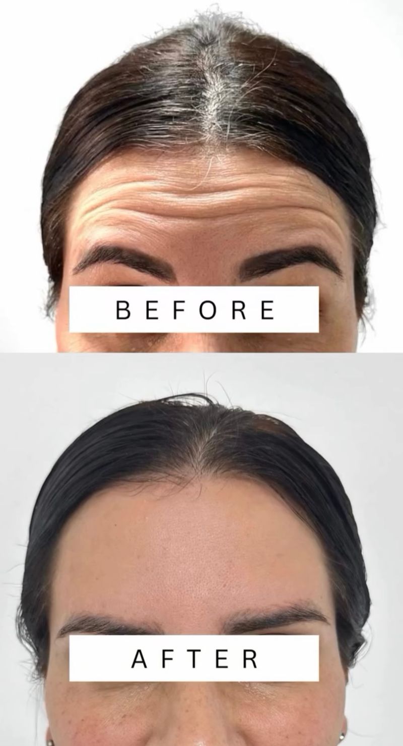 מתיחה וזוהר בזכות בוטוקס