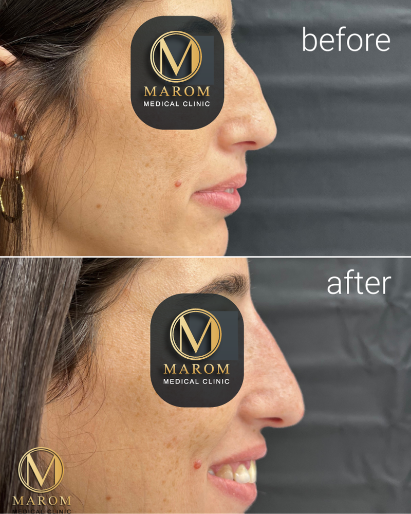 פיסול פנים מלא קו לסת \ פיסול אף \ נזולביאל \ עצמות לחיים...