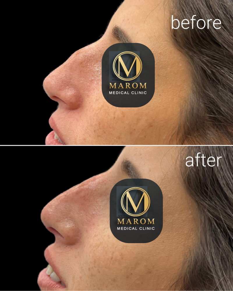 פיסול פנים מלא קו לסת \ פיסול אף \ נזולביאל \ עצמות לחיים...