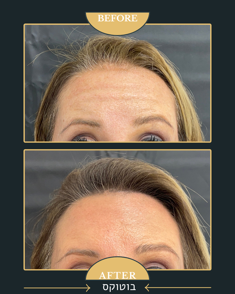 מתיחה וזוהר בזכות בוטוקס